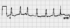 Here+is+an+ECG+that+you+could+be+presented+with+as+an+F1+on+the+ward.+%0D%0A1.+Can+you+see+regular+p+waves+before+the+QRS+complex%3F+%0D%0A2.+What+is+the+ventricular+rate%3F++%0D%0A3.+Is+the+rate+regular%3F